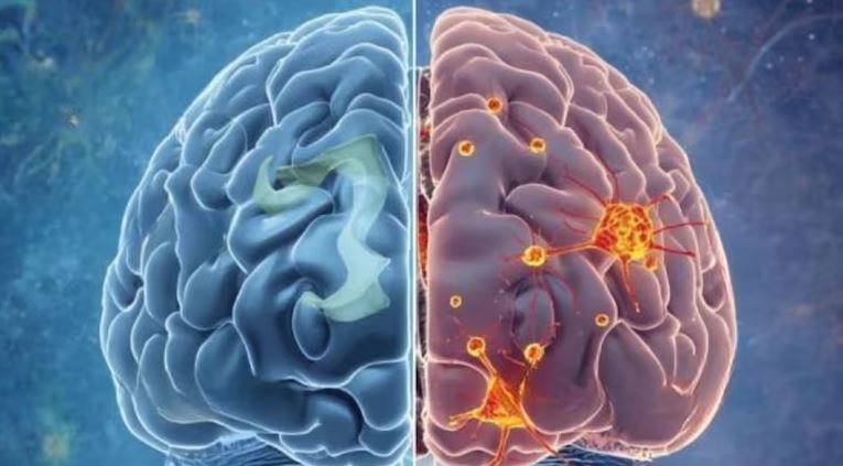 Illustration comparing a healthy brain and an Alzheimer's-affected brain showing neuron damage and brain cell death linked to karyoptosis.